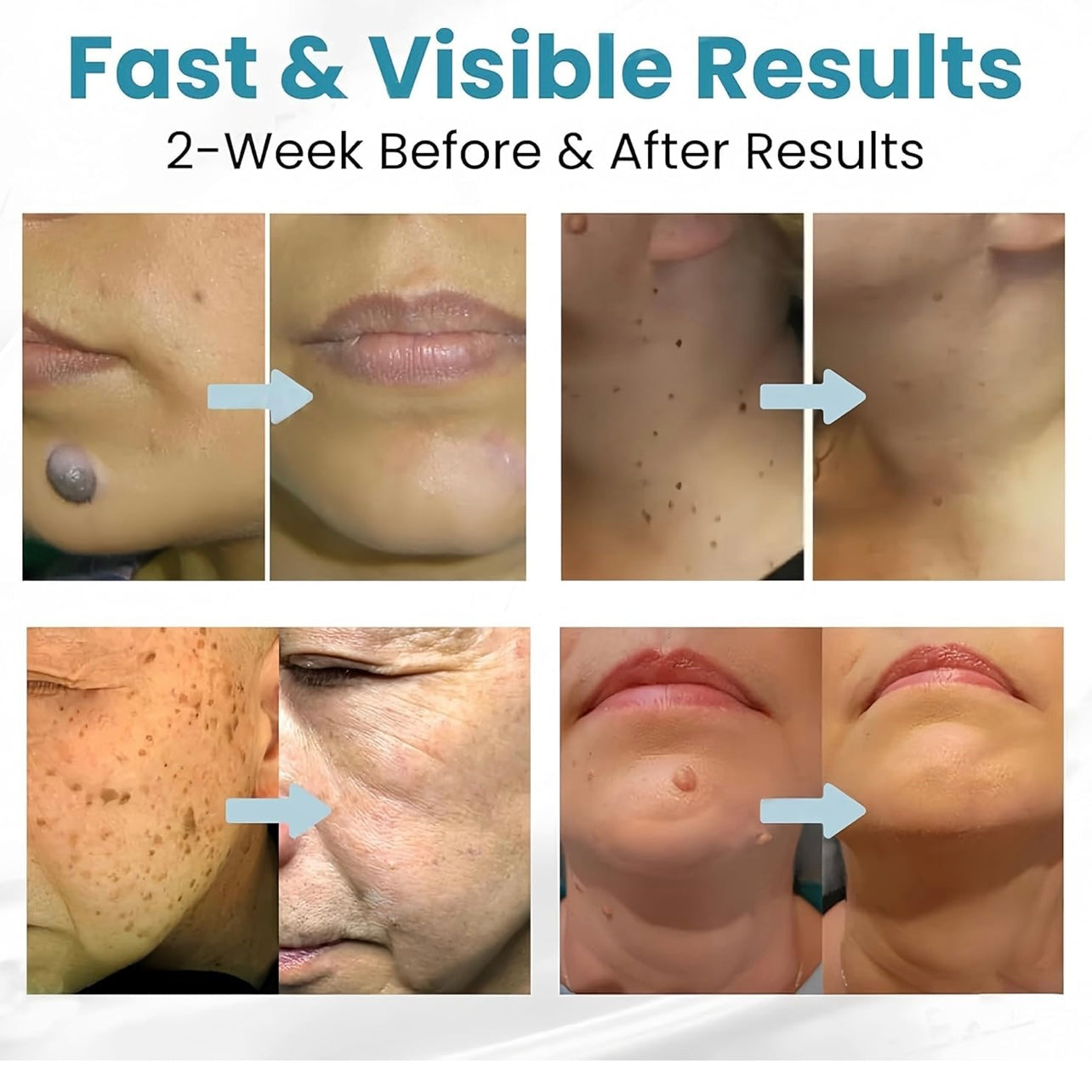 Non-Invasive Mole and
Wart Removal Laser Pen in just 2499